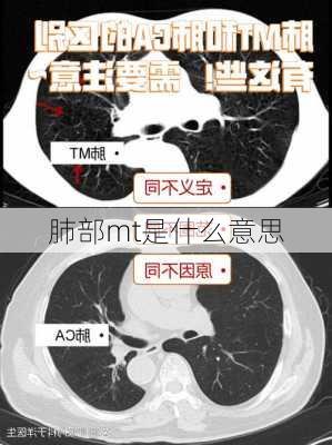 肺部mt是什么意思